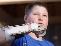 Robohand uses 3D printing to replace lost digits