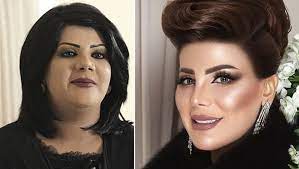 شكلي قبل و بعد عملية التجميل في كوريا | انصدمت من الصور شوفو بعيونكم الجزء التاني results of my plastic surgery in korea | id. Ø´Ø§Ù‡Ø¯ Ø§Ù„Ù‡Ø§Ù… Ø§Ù„ÙØ¶Ø§Ù„Ø© Ù‚Ø¨Ù„ ÙˆØ¨Ø¹Ø¯ Ø§Ù„ØªØ¬Ù…ÙŠÙ„ Ù‡Ù„ ØªØºÙŠØ±Øª ÙƒØ«ÙŠØ±Ø§ Ø¬Ø±ÙŠØ¯Ø© Ù†ÙˆØ±Øª