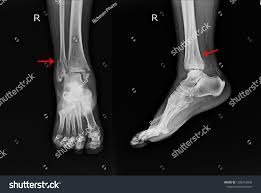 Image result for Ankle XRay