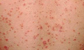 Placas hiperqueratósicas discretas nas palmas das mãos e/ou plantas dos pés que tendem a se tornar confluentes. Como Parece Psoriase Psorilax