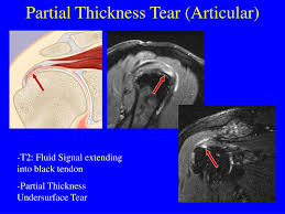 Ppt Mr Imaging Of The Rotator Cuff Powerpoint Presentation Free Download Id 3407771