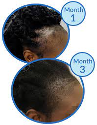 Only that you have to check those treatment hair dyes to apply to your natural hair with less chemicals to name a few like parables, phosphates or sulfate. Hair Loss Conditions Which Disproportionately Affect Black Women