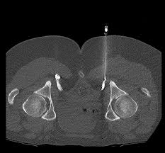 Image result for Pudendal Block