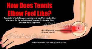 Symptoms of tennis elbow, also called elbow tendonitis, range from mild to debilitating, depending on several variables: How Does Tennis Elbow Feel Like