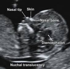 How many babies you are the blood test performs better from 10 weeks gestation and the nuchal scan performs best at 12 weeks gestation, although both tests can be done. Can T Get An Accurate Nuchal Translucency Measurement Don T Let Women Miss Out Phe Screening
