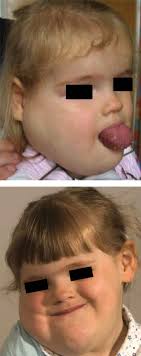 Radiofrequency ablation in the treatment of paediatric microcystic  lymphatic malformations