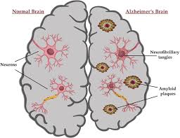 I'll leave you with one analogy, someone compared aducanumab to azt, in thinking about hiv treatments. Bace1 Inhibitors Current Status And Future Directions In Treating Alzheimer S Disease Moussa Pacha 2020 Medicinal Research Reviews Wiley Online Library