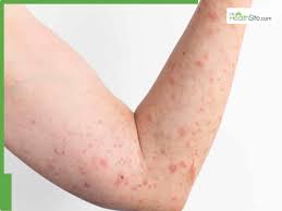 Image result for sweat rash on back baby