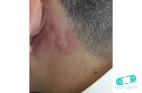 We did not find results for: Guia De La Piel Picadura De Insecto
