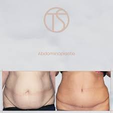 Plastie du ventre qui vise à aplatir le ventre en éliminant l'excès de graisse et de peau. L Abdominoplastie Docteur Thomas Sorin Chirurgie Esthetique Plastique Et Reconstructrice Bordeaux Docteur Thomas Sorin Chirurgie Esthetique Plastique Et Reconstructrice Bordeaux