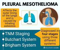 Mesothelioma — who does it hurt? Doctors Stage Mesothelioma According Mesothelioma Guide Facebook