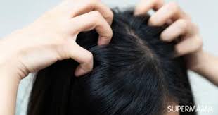 5 أسباب لحكة فروة الرأس وعلاجها سوبر ماما