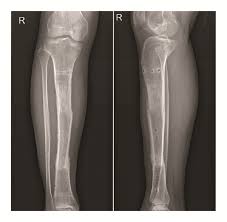 Image result for Osteomyelitis