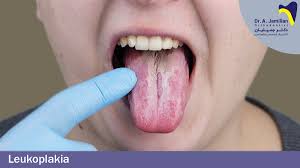 Image result for white cancer on tongue)