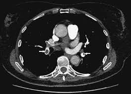 L'embolia polmonare è una patologia causata dall'ostruzione di un vaso sanguigno a livello del la diagnosi di embolia polmonare è fondamentale per fornire soccorso tempestivo al paziente ed è. Embolia Polmonare Sciencedirect