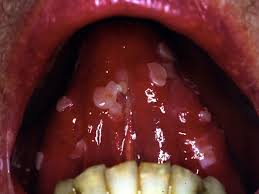Image result for Mouth ulcers symptoms roof of the mouth