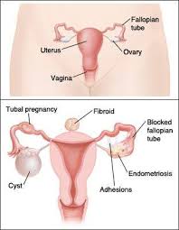 Punca cyst yang terakhir ialah genetik. Pengedar Jamu Zuriat Yusof Zulaikha Fibroid Dan Cyst Punca Utama Wanita Sukar Hamil 1 Fibroid Ketumbuhan Biasa Dan Bukannya Kanser Yang Terdapat Di Dalam Rahim Wanita Kebiasannya Fibroid Muncul Sebagai Tumbuhan