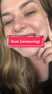Gum Contouring (gingivectomy) is something I’ve wanted for more than 6  years to correct my gummy smile! Magic City Dentistry Dr. Carson Pruitt in  Bham, AL was the absolute best and left me with nearly ...