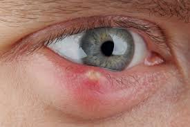 Image result for Eye Pain