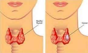 When it does happen, the cancer is usually found by accident because of tests done for other medical problems. Throat Cancer Types Facts Symptoms Signs Of Throat Cancer Sandybook