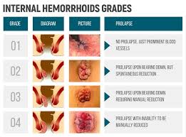 Image result for hemorrhoids