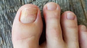 Image result for onychomycosis