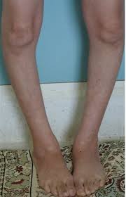 Image result for Genu Varum