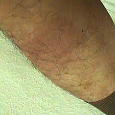 Manchas Rojas En Las Ingles Pecho Y Granos Con Picor Cerca Del Ano Dermatologo Net