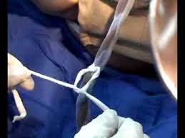 Ligadura De Cordon Umbilical Youtube