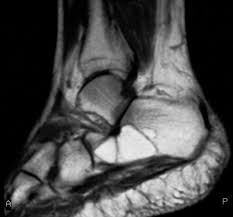 Radiographic evaluation of haglund's deformity. Painful Heel Mr Imaging Findings Radiographics