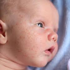 Ces petits boutons sont apparus sur le front, le nez et les joues de votre bébé. Acne Du Nourrisson Doctissimo