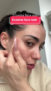 Image result for ekzema face