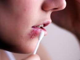 If you develop signs and symptoms of herpes simplex, you can expect to have these for as long as listed below Herpes In Females Symptoms Diagnosis And Treatment