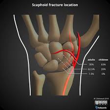Image result for Scaphoid Bone