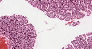 Celiac disease and dermatologic manifestations: Celiac Disease Amboss