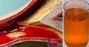 Damarlari Yeniden Dogmus Gibi Yapacak Bitkilog Health Remedies Natural Health Remedies Clogged Arteries