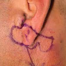 Not only does the stage tell you how serious the disease is, but it can help you and. Malignant Melanoma Of The Left Earlobe With Planning Of The Gavello Download Scientific Diagram