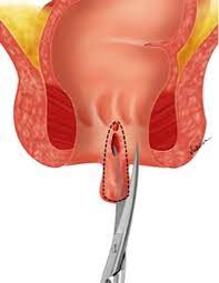 SciELO - Brasil - Anoplastia com plicoma sentinela para o tratamento de  fissura anal crônica. Anoplastia com plicoma sentinela para o tratamento de  fissura anal crônica.