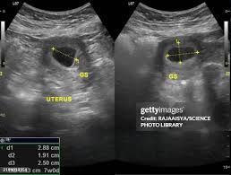 Image result for First Trimester Ultrasound