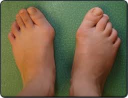 Image result for Hallux Varus