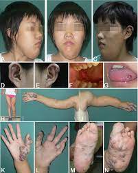 Genetic Variation Analysis In A Chinese Maffucci Syndrome Patient Sciencedirect