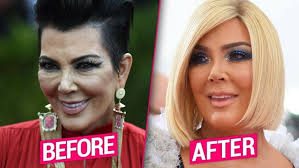 Patreon Plastic Surgery Plastic Surgery Photos Rhinoplasty