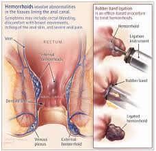 Image result for hemoroid human
