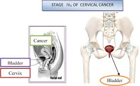 You'll have your first one when you are about 25, and they happen every three years until you're 49, and then every five years if you're aged between 50 and 64. Frontiers Cervical Cancer Different Treatments And Importance Of Bile Acids As Therapeutic Agents In This Disease Pharmacology