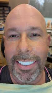 Implant Supported Teeth > Dentures 🤍, This patient is an integral part of  our community who always puts others first! So happy he invested in  himself. , This is ~24 hours post surgery. , ...