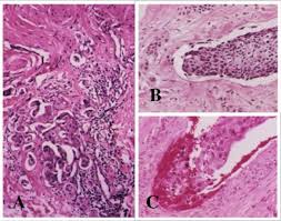 Your breast may ache or feel tender. Inflammatory Breast Cancer Moose And Doc