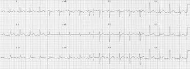 The ratio of the amplitude of st segment to the amplitude of the t wave in leads i, v4, v5, and v6 on electrocardiogram can be used to differentiate acute pericarditis (ap) from early repolarization (er) and early repolarization of left ventricular hypertrophy (erlvh), according to a recent study. Pericarditis Ecg Changes Litfl Ecg Library Diagnosis