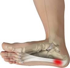 Plantar Fasciitis Treatment Vienna Va Plantar Fasciitis Causes Herndon