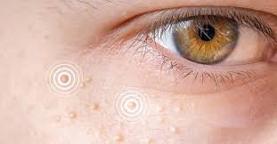 Image result for xanthelasma of eyelid