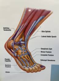 Image result for Foot Fracture